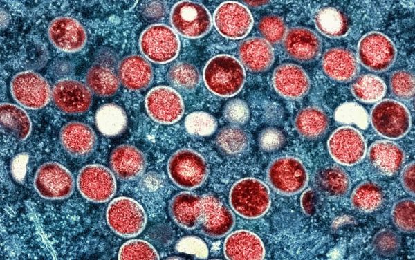 Mpox has not gone away, leading sexual health charity warns